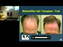 Health at Google: Hair Loss and Hair Restoration by William Rassman